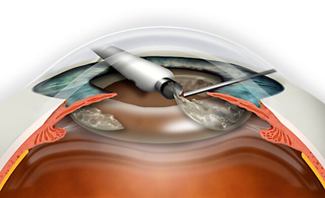 The refractive replacement of the lens is performed through the micronadle, which excludes blood loss