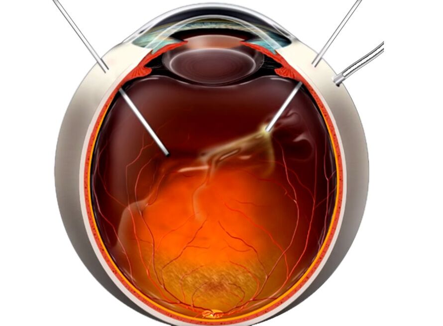 Vitrectomy - A procedure shown to people when the retinal exfoliation